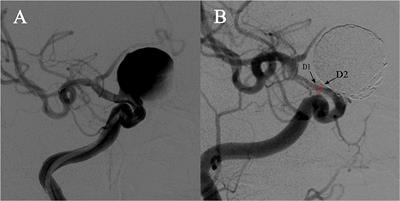 Tortuosity of parent artery predicts in-stent stenosis after pipeline flow-diverter stenting for internal carotid artery aneurysms